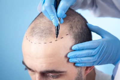 Transplante capilar - Cirugia plastica granada
